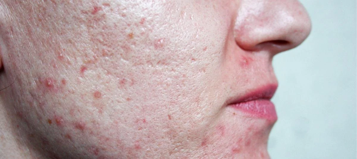 https://www.reequil.com/cdn/shop/articles/Relation_between_large_pores_oily_skin_and_acne_-_desktop.jpg?v=1770666491